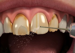 Porcelain Veneers